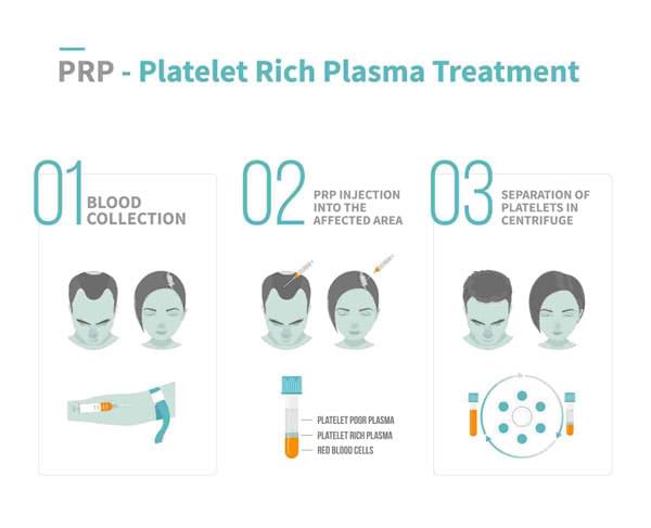 Platelet Rich Plasma Treatment